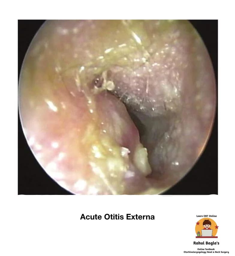 Diffuse Acute Otitis Externa (Swimmer’s ear). Dr. Rahul Bagla ENT Textbook. Diseases of External Ear