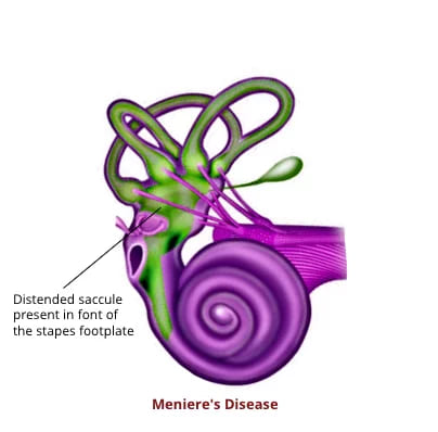 Meniere's disease cochlea. Dr. Rahul Bagla ENT Textbook