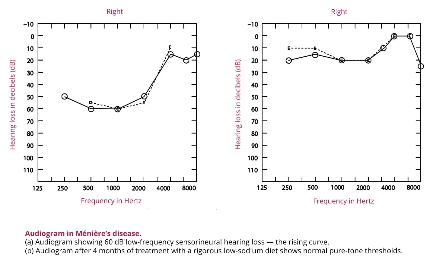 Meniere’s disease Etiology, Pathophysiology, Clinical Features