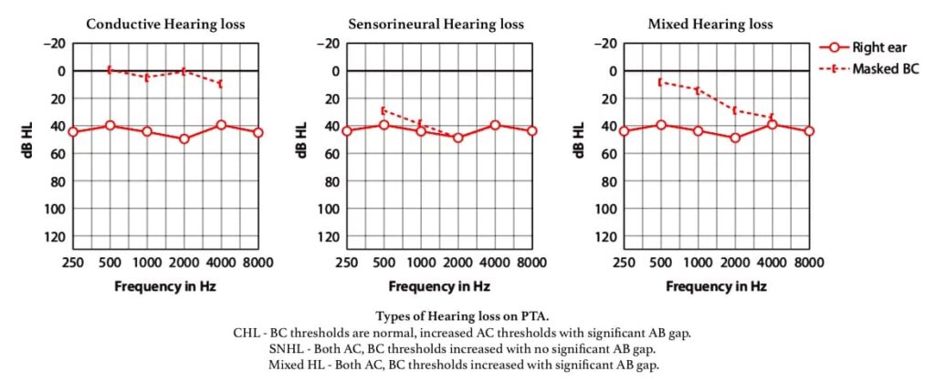 Types of Hearing loss