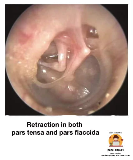 Retraction, Retraction Pockets and Atelectasis of Tympanic Membrane. Dr. Rahul Bagla ENT Textbook. Diseases of External Ear