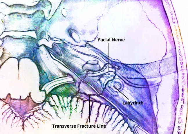 Transverse fracture. Dr. Rahul Bagla ENT Textbook