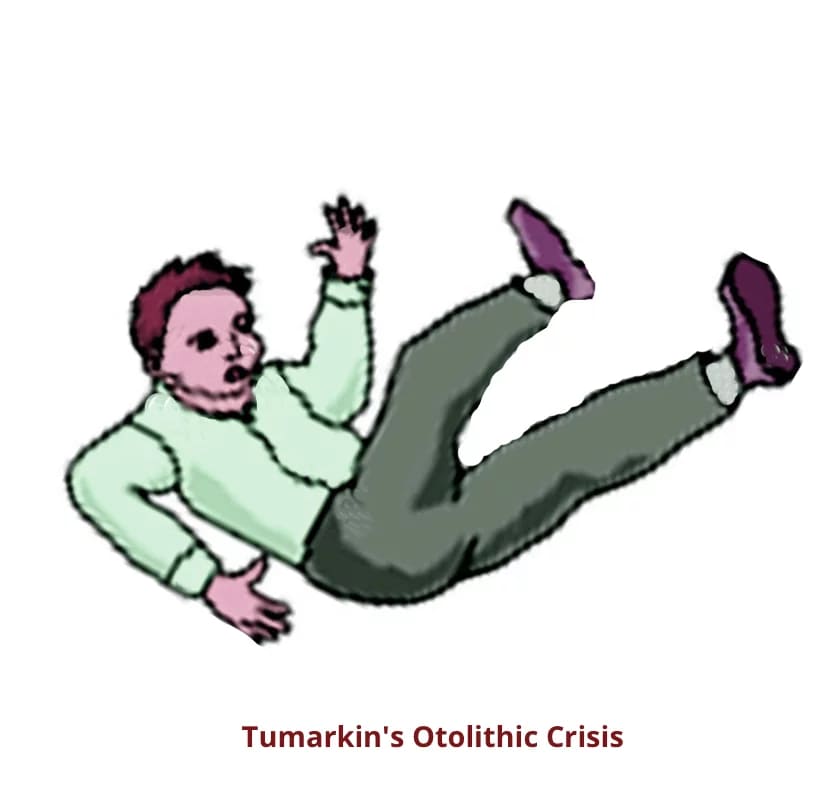 Tumarkin’s otolithic crisis. Dr. Rahul Bagla ENT Textbook