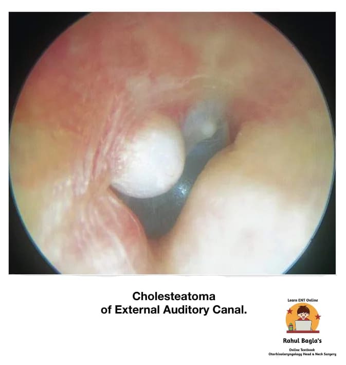 Cholesteatoma of External Auditory Canal. Dr. Rahul Bagla ENT Textbook. Diseases of External Ear