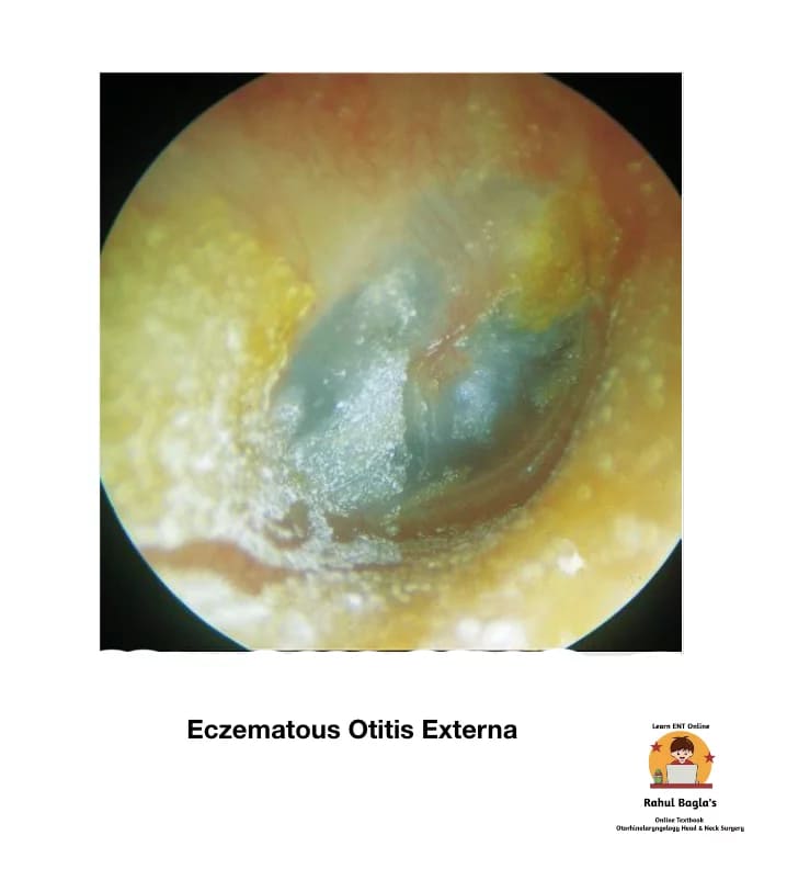 Eczematous Otitis Externa. Dr. Rahul Bagla ENT Textbook. Diseases of External Ear