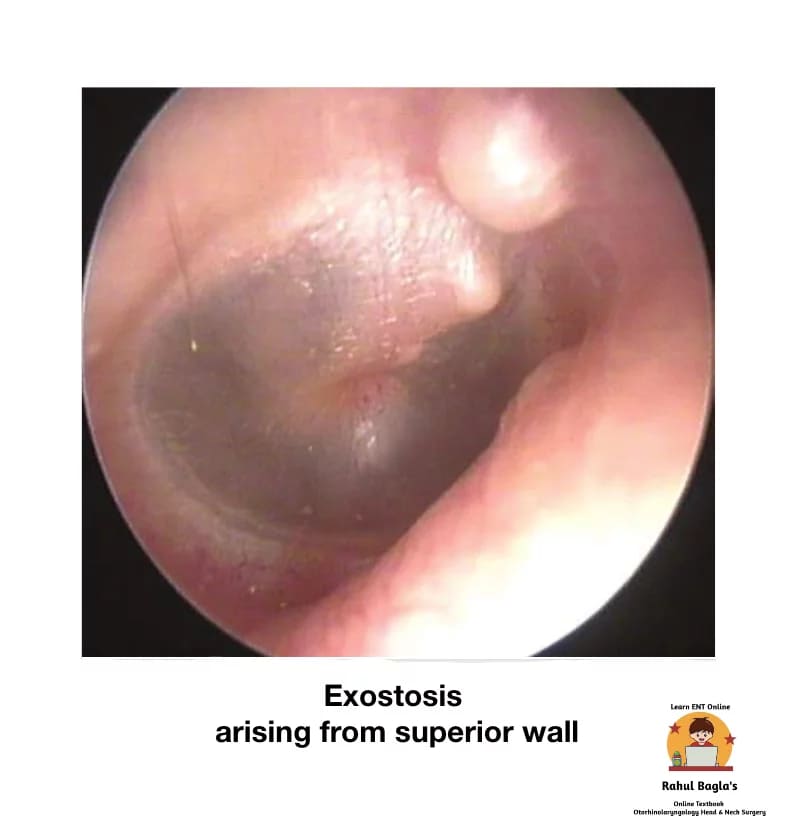 Exostosis. Dr. Rahul Bagla ENT Textbook. Diseases of External Ear