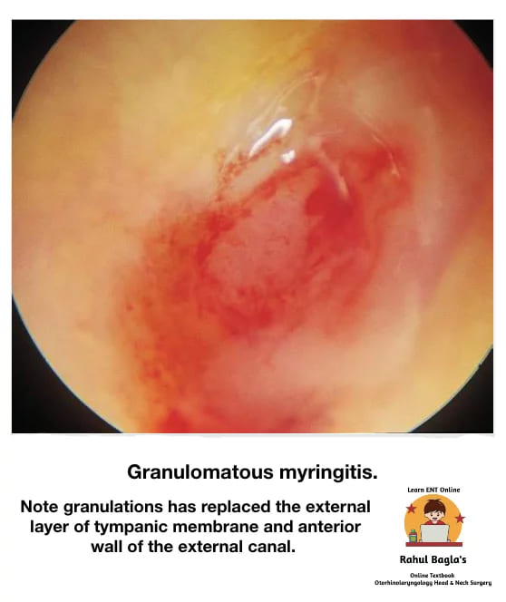 Granulomatous Myringitis. Dr. Rahul Bagla ENT Textbook. Diseases of External Ear