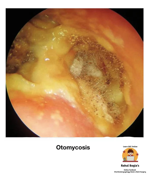 Otomycosis. Dr. Rahul Bagla ENT Textbook. Diseases of External Ear