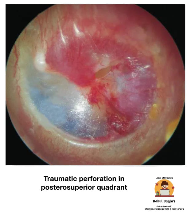 Traumatic rupture of tympanic membrane. Dr. Rahul Bagla ENT Textbook. Diseases of External Ear