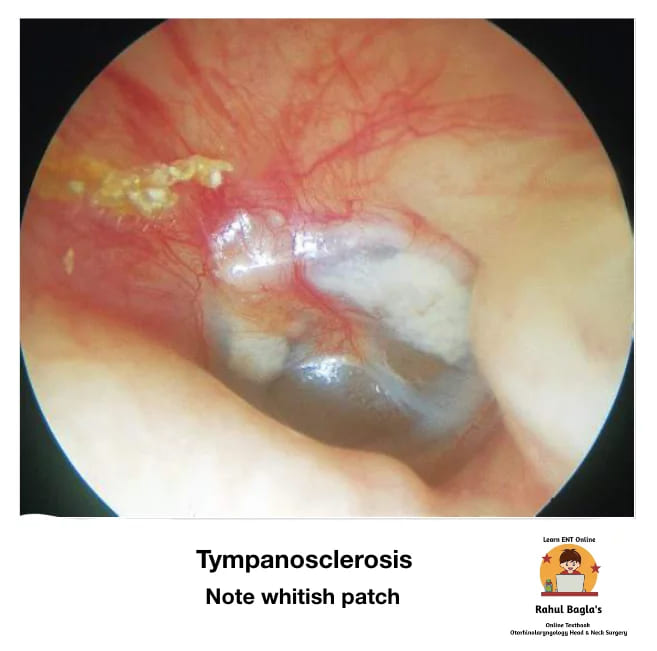 Tympanosclerosis. Dr. Rahul Bagla ENT Textbook. Diseases of External Ear