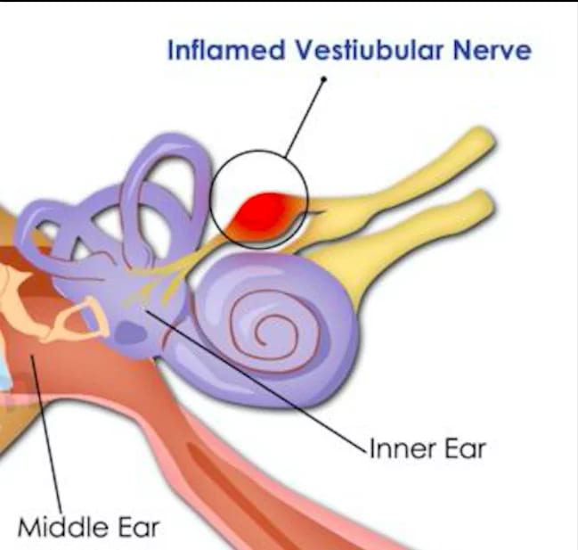 Vestibular Neuritis. Dr Rahul Bagla ENT Textbook