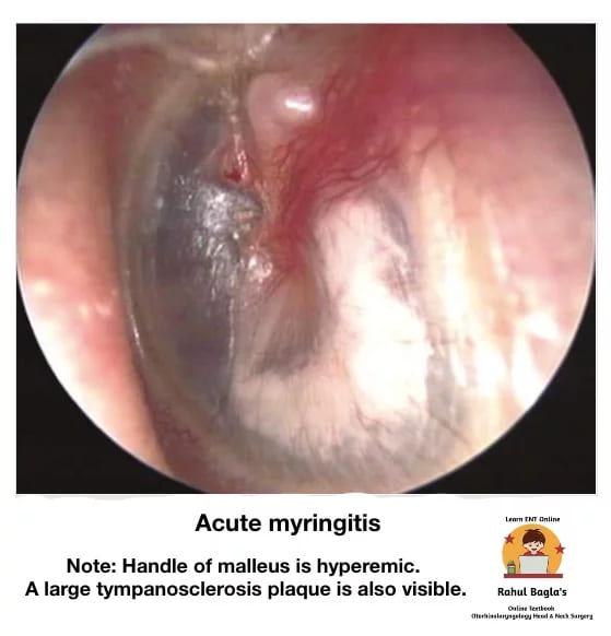 Myringitis. Dr. Rahul Bagla ENT Textbook. Diseases of External Ear