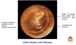 Otitis Media With Effusion How Serous Otitis Media Affects Hearing 