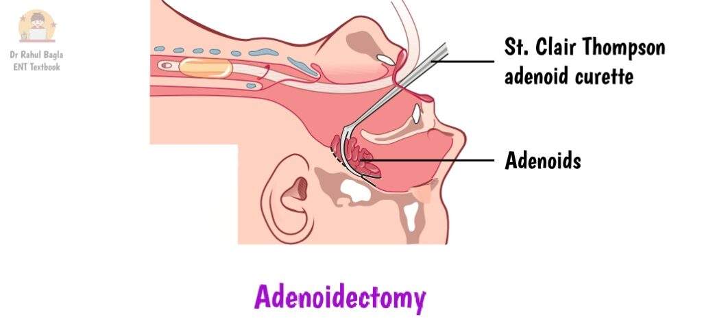 Adenoidectomy - Steps of operation