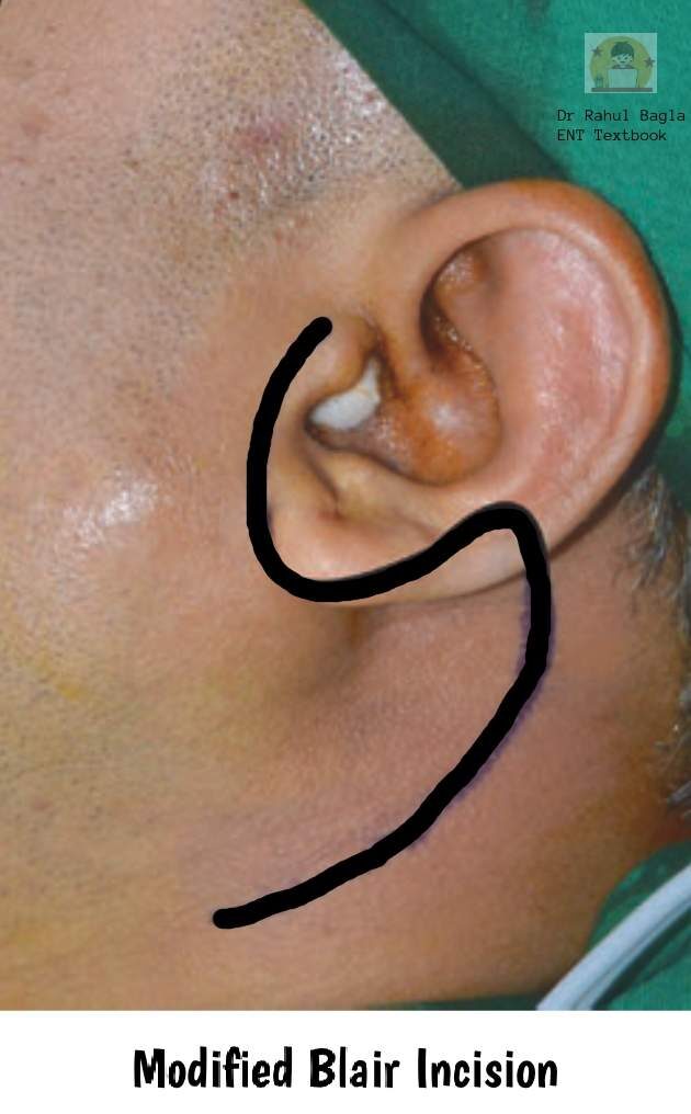 Parotid Incision Types Parotid Gland Surgery - Dr. Rahul Bagla ENT Textbook