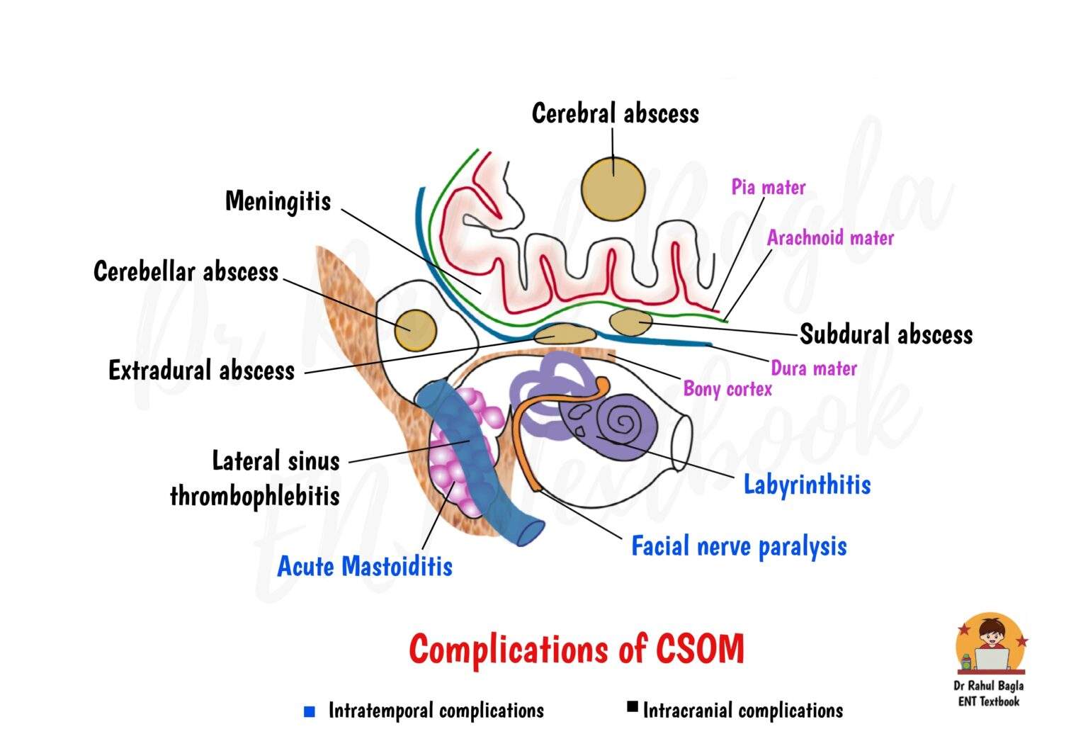 Computer Csom CSOM Complications: Notes for MBBS, ENT PG & NEET PG