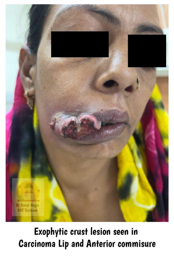 Exophytic crust lesion seen in Carcinoma Lip and Anterior commisure Dr Rahul Bagla ENT Textbook