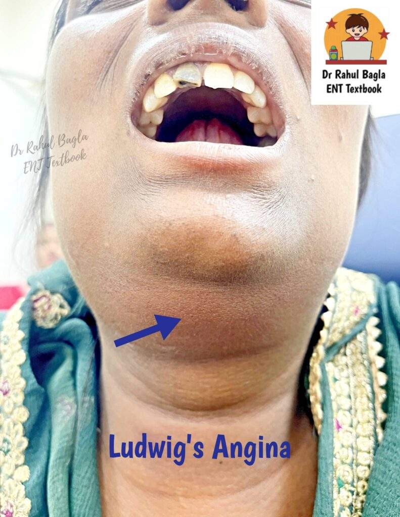 Ludwig's Angina Dr Rahul ENT Textbook Best Photo