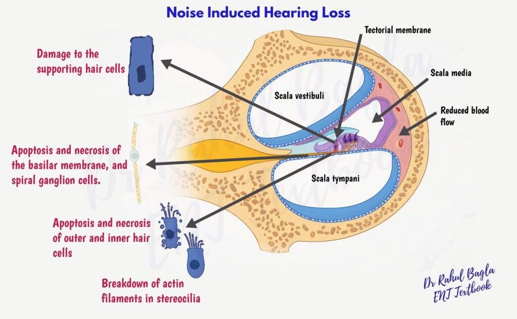 Noise Induced Hearing Loss Dr Rahul Bagla ENT Textbook