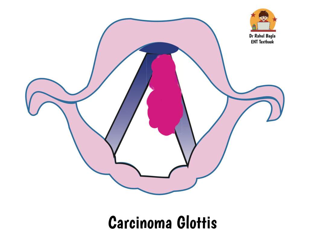 Carcinoma Glottis Dr Rahul Bagla ENT Textbook