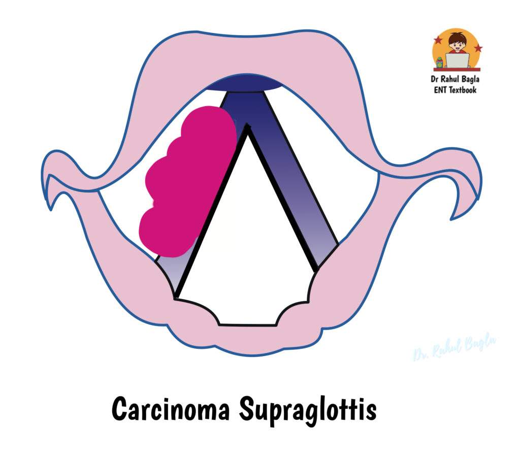 Carcinoma Supraglottis Dr Rahul Bagla ENT Textbook