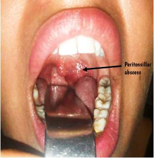Parapharangeal space abscess Dr Rahul Bagla ENT Textbook