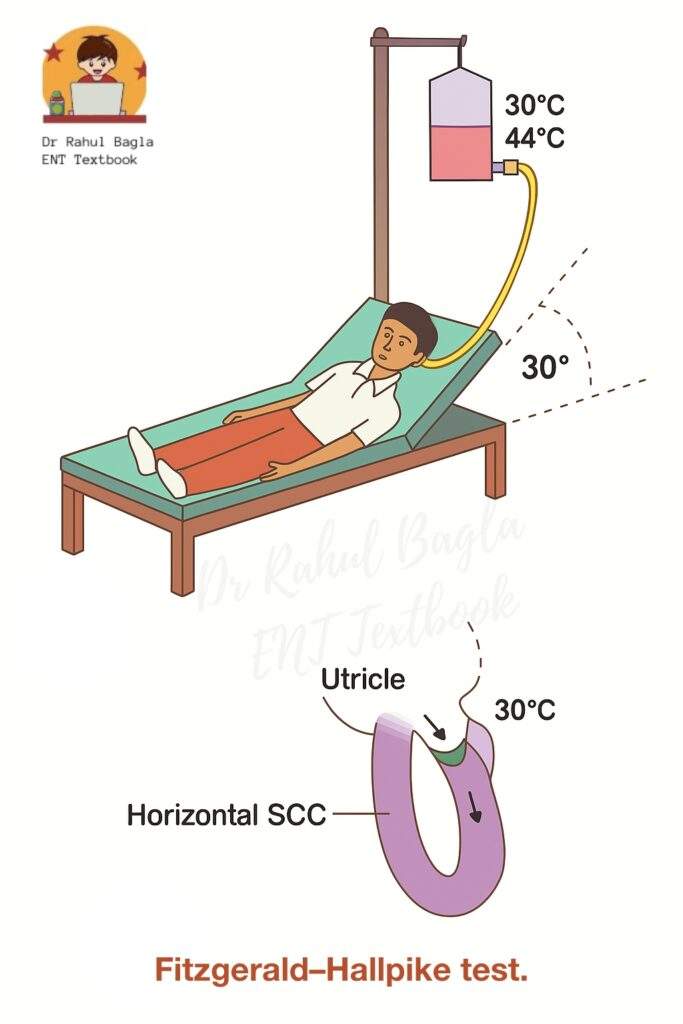 Dr Rahul Bagla ENT Textbook Caloric test Fitzgerald-Hallpike Bi-thermal Caloric Test