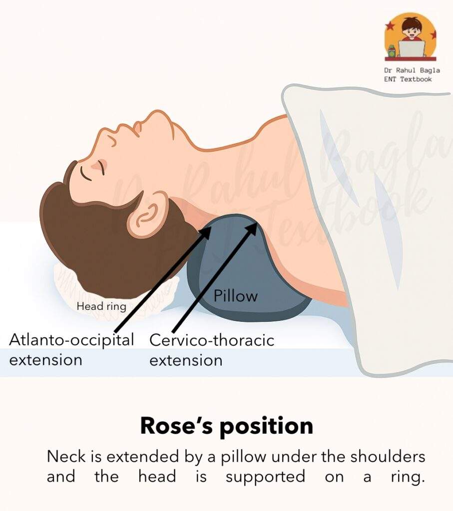 Rose’s position Tonsillectomy Dr Rahul Bagla ENT Textbook