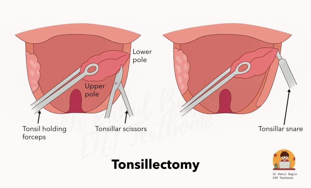 Tonsillectomy Dr Rahul Bagla ENT Textbook