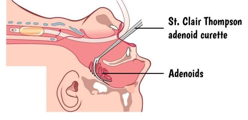 Adenoidectomy 1-Dr-Rahul-Bagla