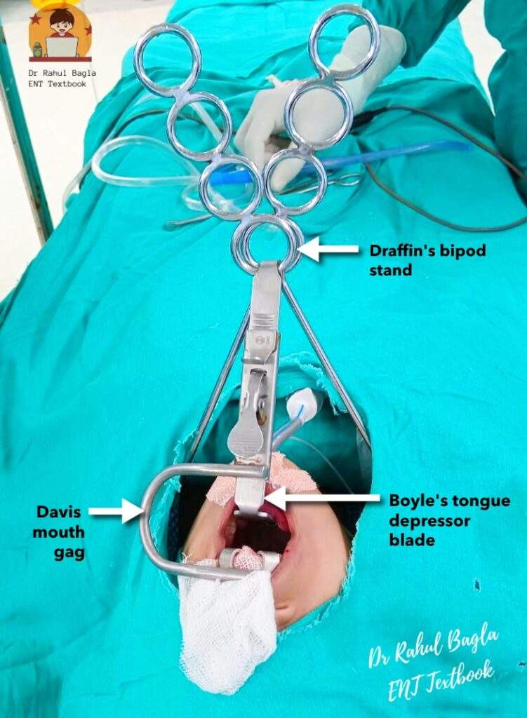 Adenotonsillectomy Dr Rahul Bagla ENT Textbook