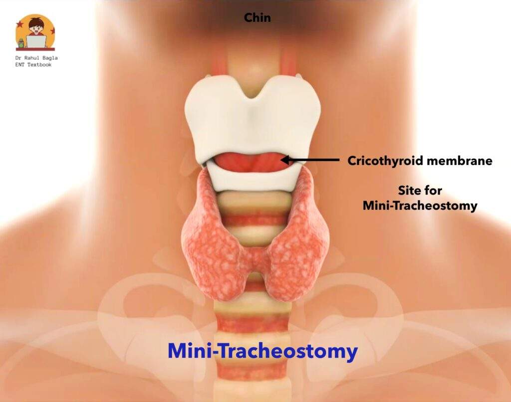 Mini Tracheostomy Dr Rahul Bagla ENT Textbook