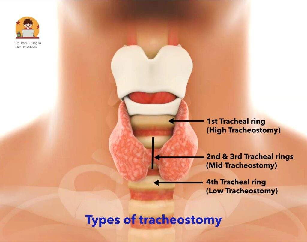 Types of tracheostomy Dr Rahul Bagla ENT Textbook