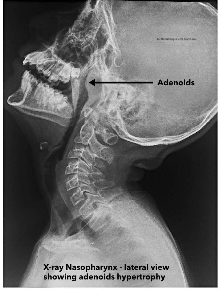 X-ray Nasopharynx - lateral view showing adenoids hypertrophy Dr Rahul Bagla ENT Textbook