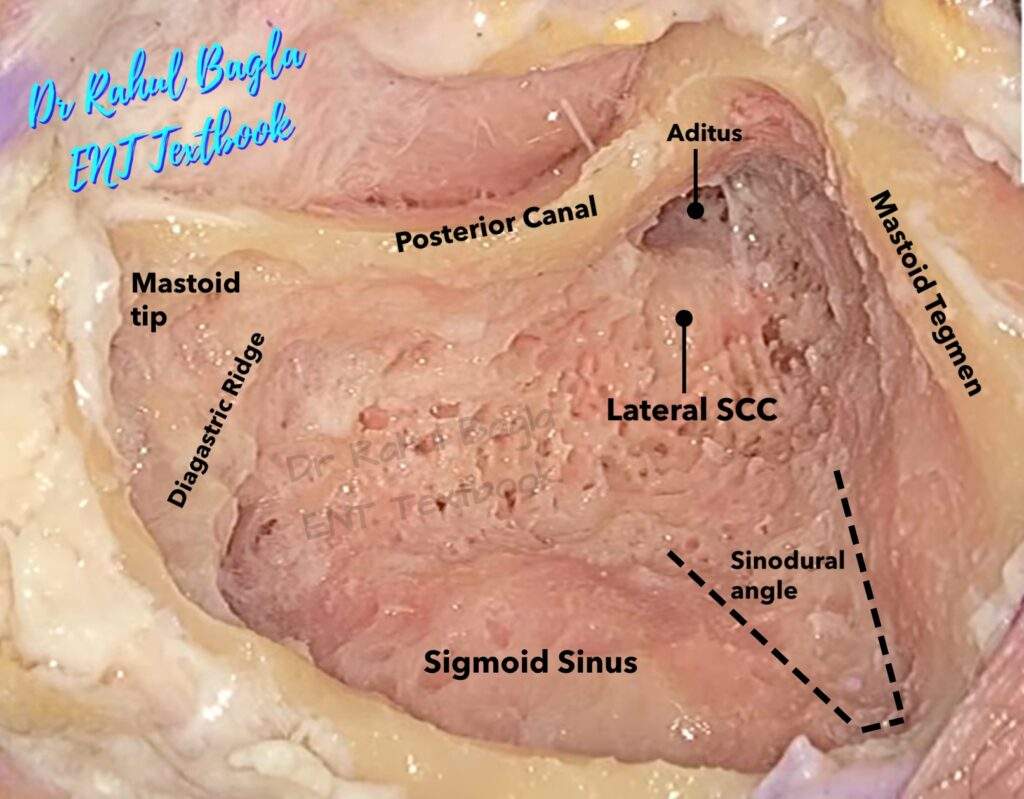Cortical Mastoidectomy Sinodural Angle Dr Rahul Bagla ENT Textbook