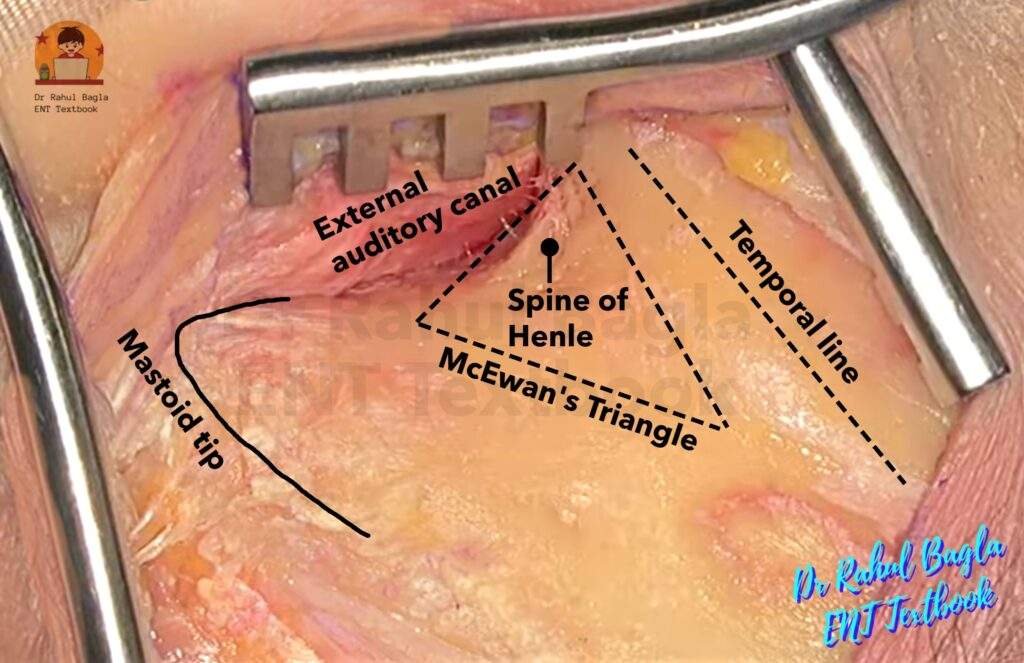 Cortical Matoidectomy McEwan's Triangle Dr Rahul Bagla ENT Textbook