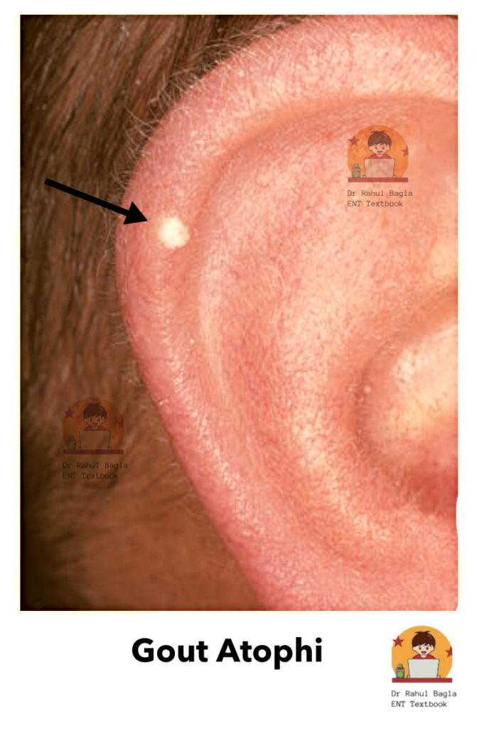 Gout (Atophi) Dr Rahul Bagla ENT Textbook