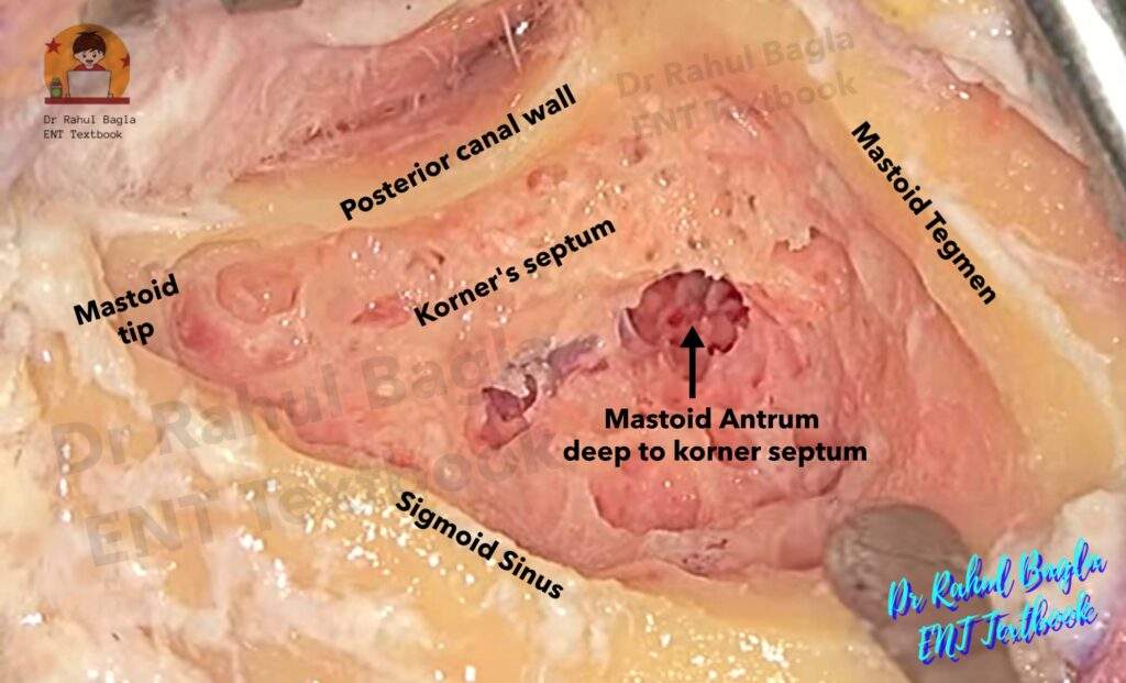 Korner's septum Mastoid antrum Dr Rahul Bagla ENT Textbook