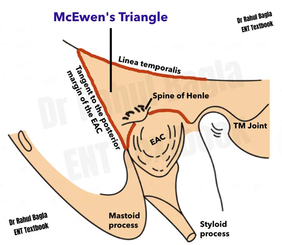McEwen's Triangle Dr Rahul Bagla ENT Textbook