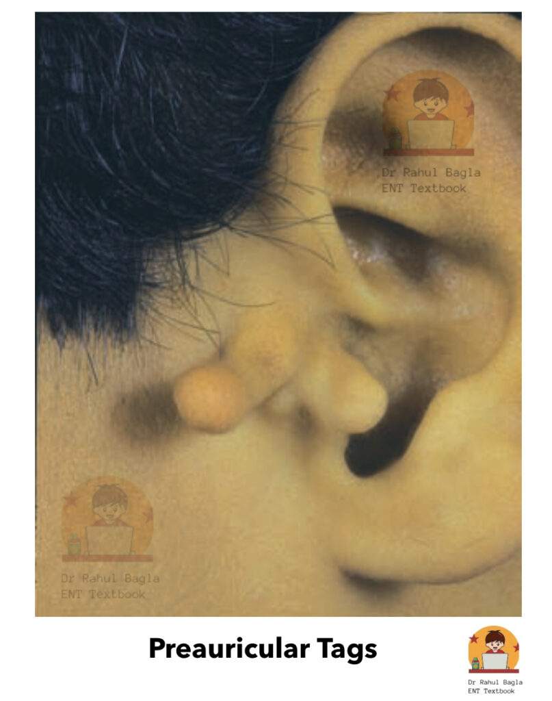 Preauricular Tags Dr Rahul Bagla ENT Textbook