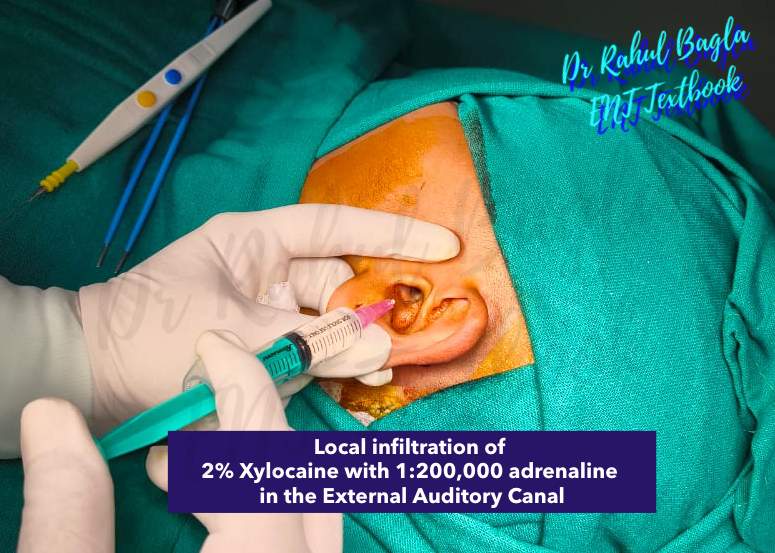 Schwartz Mastoidectomy Dr Rahul Bagla ENT Textbook