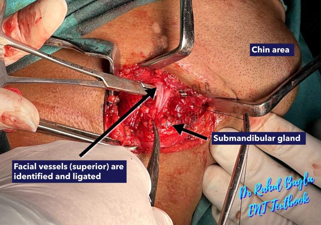 Submandibular Gland Facial Vessels Ligation Dr Rahul Bagla ENT Textbook