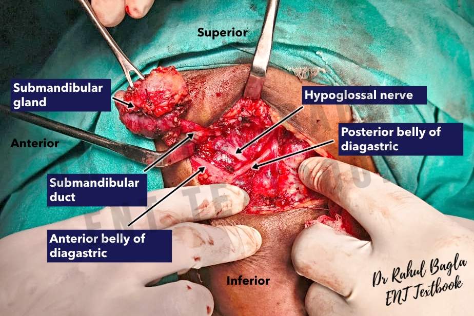 Submandibular Gland Surgery Dr Rahul Bagla ENT Textbook