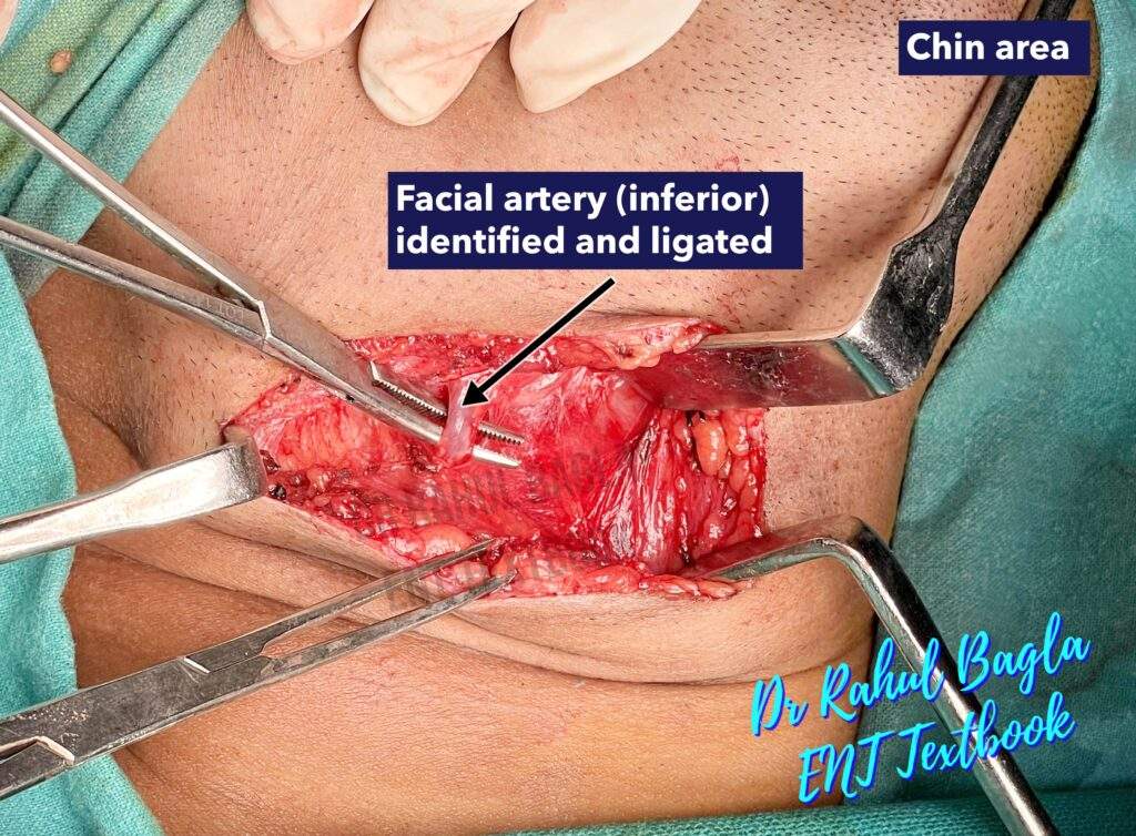 Submandibular Gland Surgery Facial Artery Dr Rahul Bagla ENT Textbook
