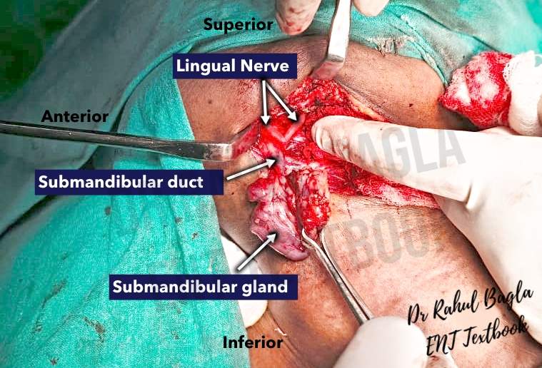 Submandibular Gland Surgery Lingual Nerve Dr Rahul bagla ENT Textbook