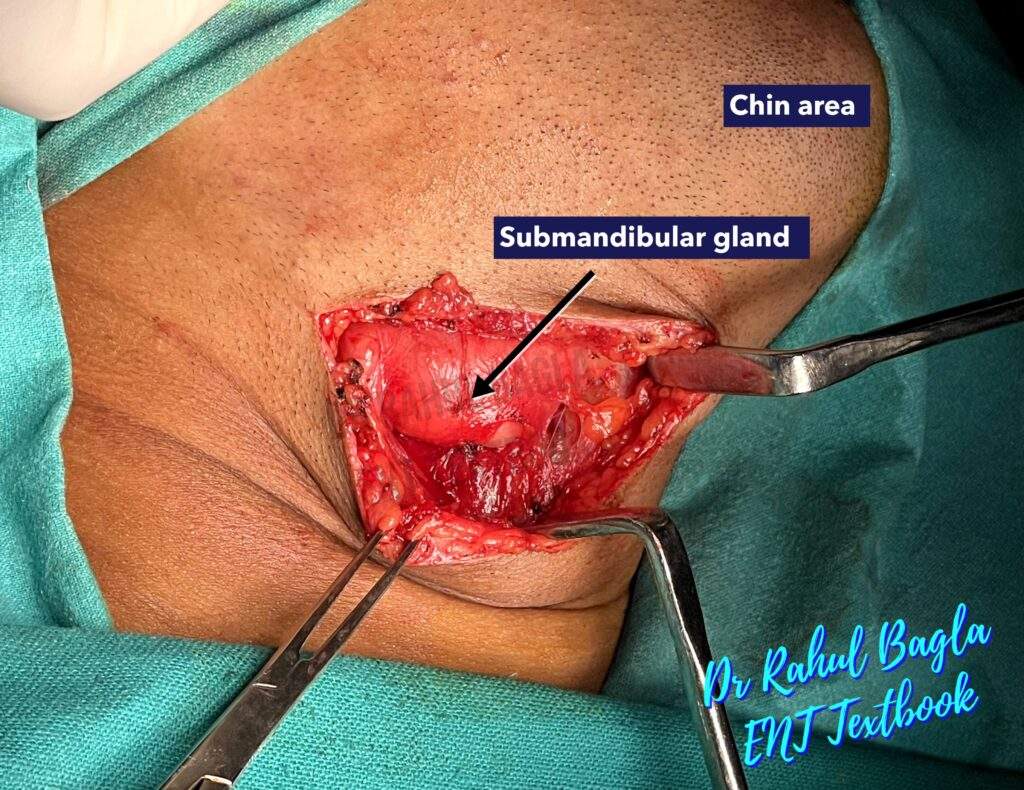 Submandibular gland Identification Dr Rahul Bagla ENT Textbook