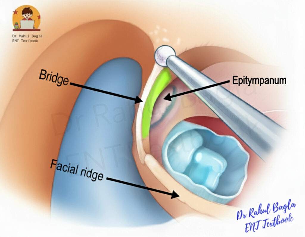 Bridge and Facial Ridge in the Mastoid Surgery Dr Rahul Bagla ENT Textbook