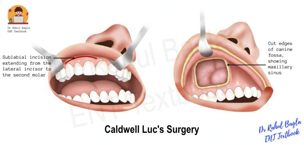 Caldwell Luc's Surgery Dr Rahul Bagla ENT Textbook