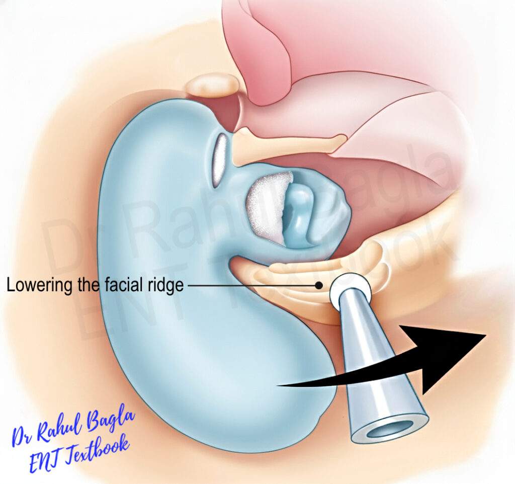 Lowering the facial ridge Dr Rahul Bagla ENT Textbook