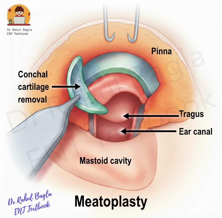 Meatoplasty Dr Rahul Bagla ENT Textbook